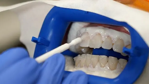 سفید-شدن-دندان2