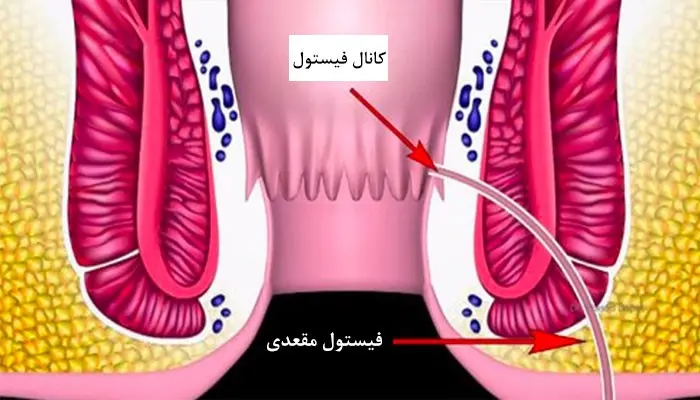 فیستول