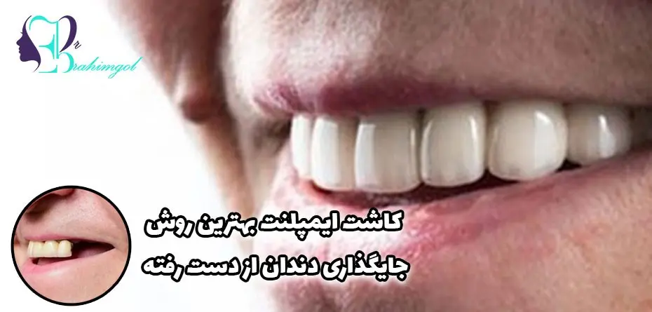 ایمپلنت-دندان-۱