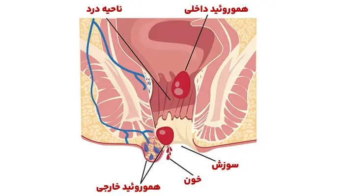 بواسیر۱
