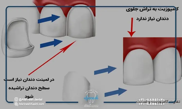 Alt: تفاوت بین کامپوزیت دندان و لمینیت دندان