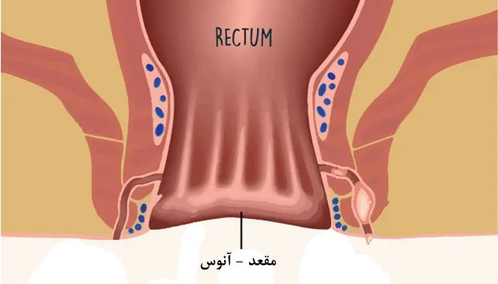 فیستول۱
