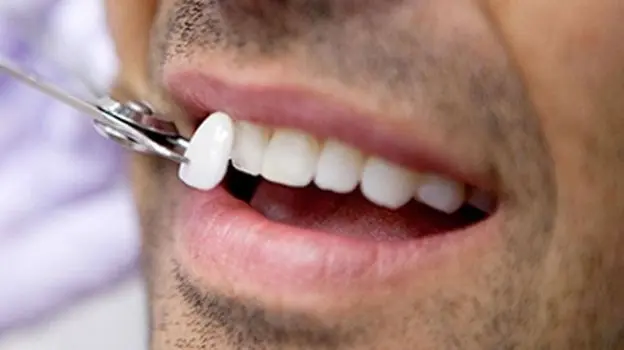 سفید-شدن-دندان1