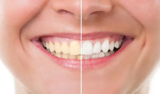 سفید-شدن-دندان