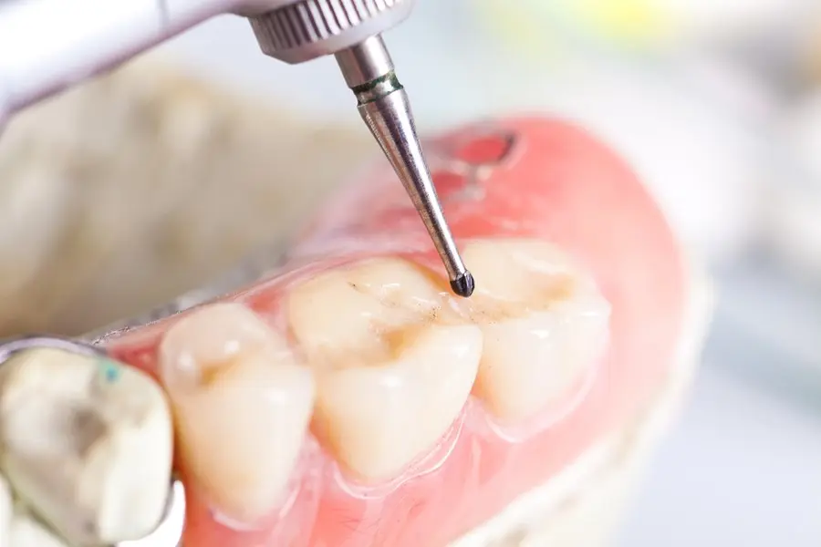 پر-کردن-دندان