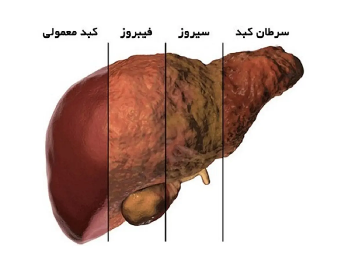 جان خود را نجات دهید | کبد چرب آخر و عاقبت ندارد! + راهکار 2