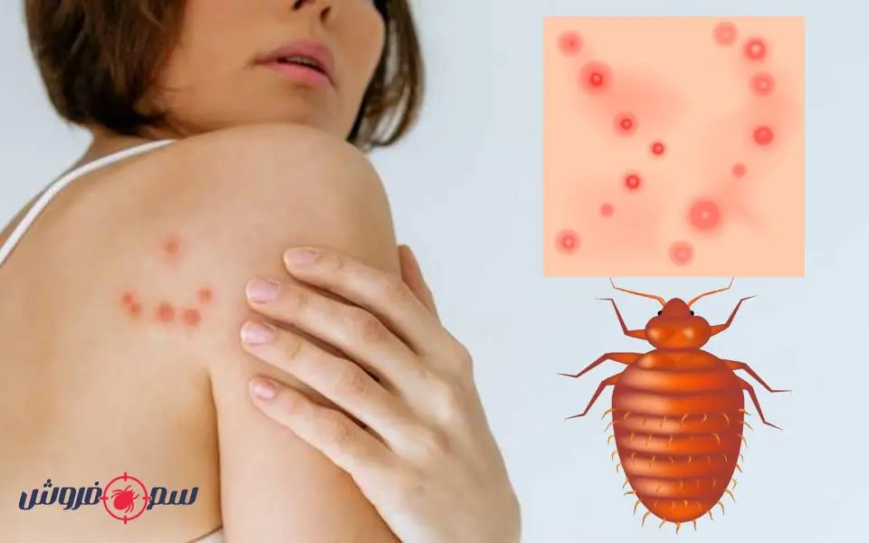 جای نیش ساس از علائم ساس در منزل