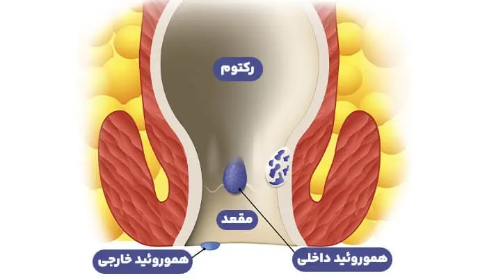 بواسیر
