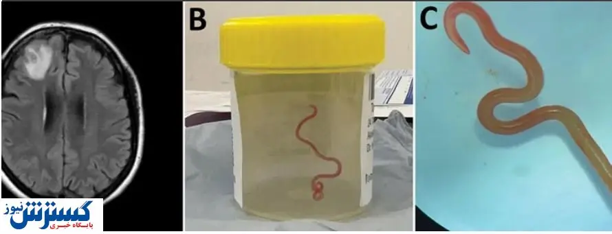 کرم زنده در سر یک زن یافت شد