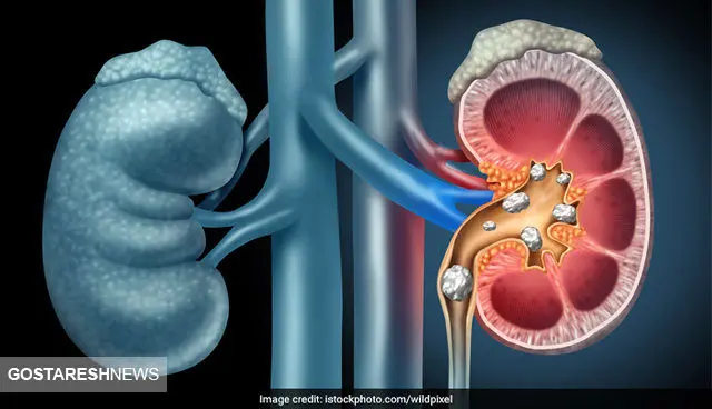 با روش های مواجهه با سنگ کلیه آشنا شوید