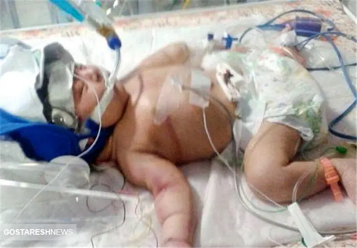 فوت تاسف برانگیز جنجالی نوزاد در بیمارستان نهاوند