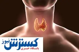کم کاری «تیروئید» را چگونه درمان کنیم؟