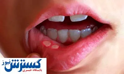 کمبود این ویتامین ها باعث آفت دهان می شود