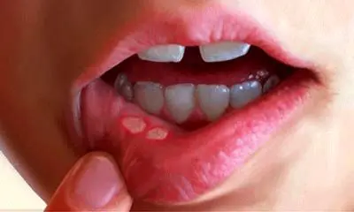 کمبود این ویتامین ها باعث آفت دهان می‌ شود