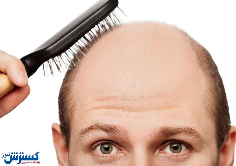 ۵ روش ارزان برای جلوگیری از ریزش موی آقایان‌