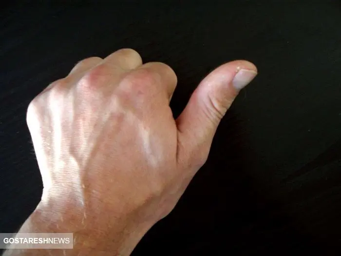 نشانه خطرناک لرزش انگشت شست 