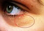 ۶ نوع عفونتی چشمی وحشتناک را بشناسید