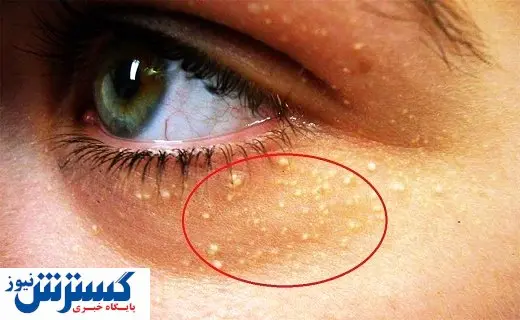 چشمها ابتلا به این بیماری خطرناک را نشان میدهند