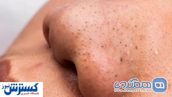 ۷ ترفند خانگی برای از بین بردن جوش های سرسیاه