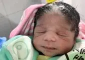 تولد یک نوزاد با ۱۲سانت دم + عکس
