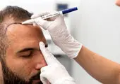 کاشت مو چگونه انجام می شود؟ انواع روش ها و عوارض