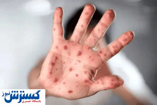 آبله میمون چگونه منتشر می شود؟