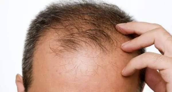 درمان ریزش موی شقیقه با این ۸ روش