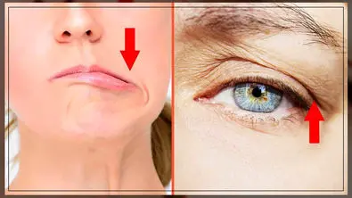 بوتاکس برای چه کسانی ضرر دارد؟ موارد منع مصرف، خطرات و عوارض جانبی