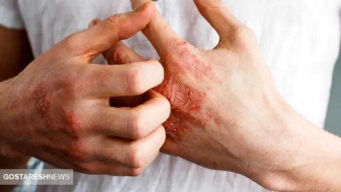عارضه دردناک خارش پوست + درمان خانگی
