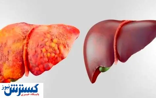 بیماری خطرناک کبد چرب با این علائم می آید
