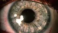 کمک سلولهای بنیادی به پایان نابینایی 