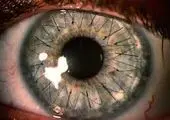 کمک سلولهای بنیادی به پایان نابینایی 
