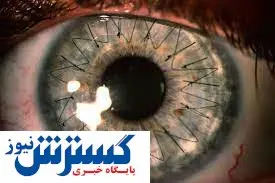 درمان نابینایی با سلولهای بنیادی
