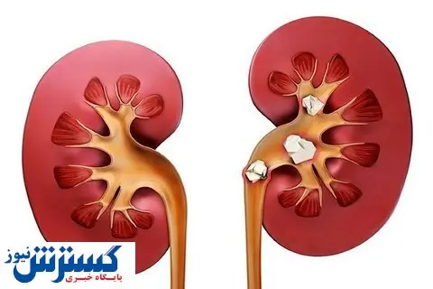 روش‌های درمان سنگ کلیه + عکس