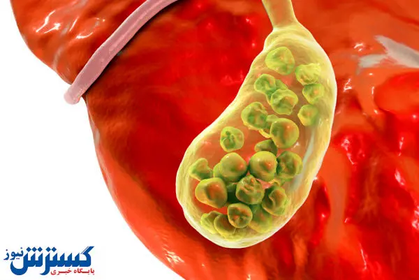درباره درمان سنگ کیسه صفرا چه میدانید؟