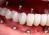 آشنایی با انواع ایمپلنت و قطعات ایمپلنت دندانی