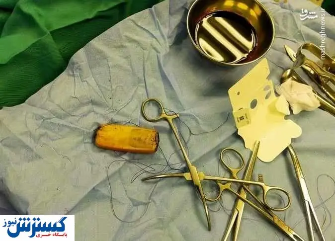 خارج کردن یک گوشی موبایل از معده بیمار پس از ۶ ماه + عکس