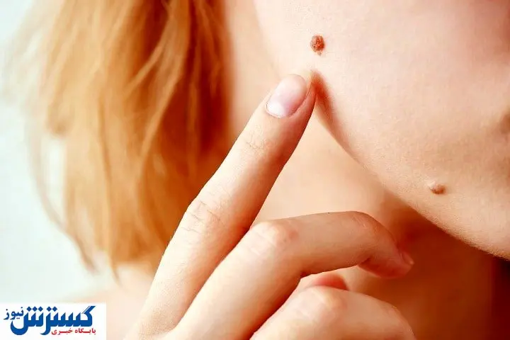 راه حل ساده برای از بین بردن خال های بدن