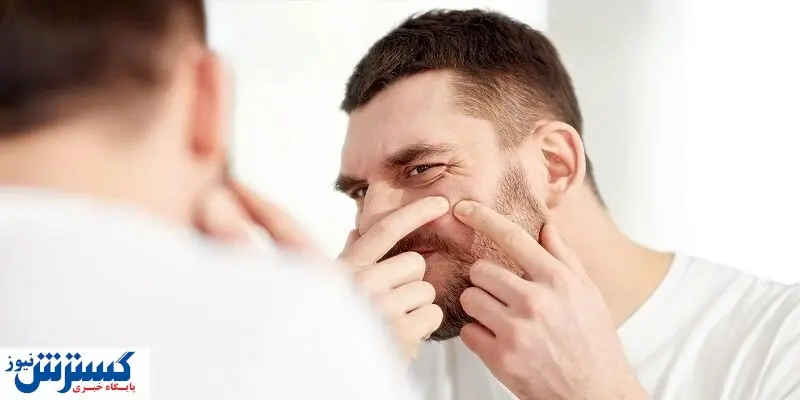 چند راهکار ساده برای از بین بردن جای جوش در خانه