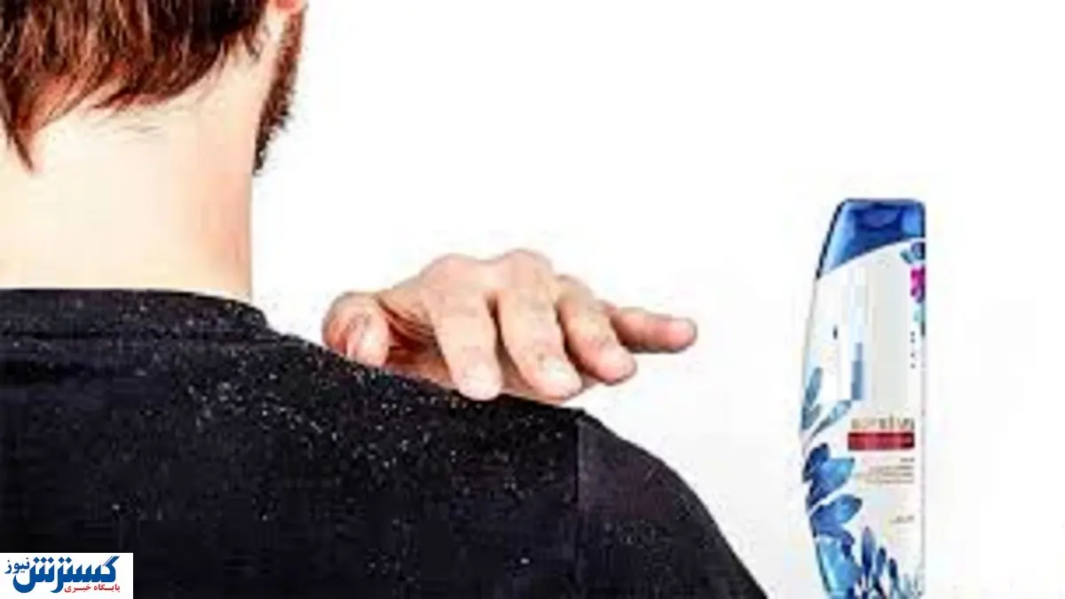 برای شامپو ضد شوره چقدر هزینه کنیم؟